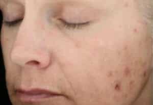 Before Image: Chemical Peels