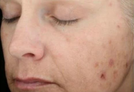 Before Image: Chemical Peels - left-front-oblique
