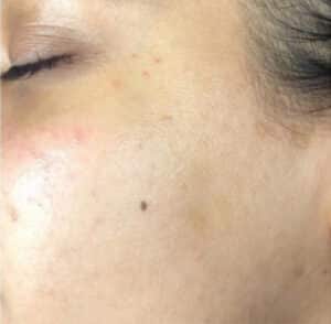 After Image: Dermaplaning
