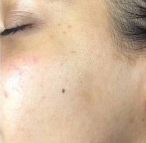 After Image: Dermaplaning - left-front-oblique