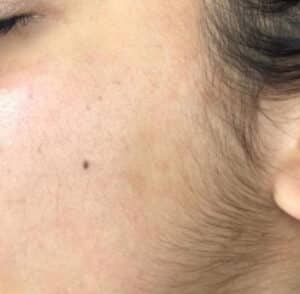 Before Image: Dermaplaning