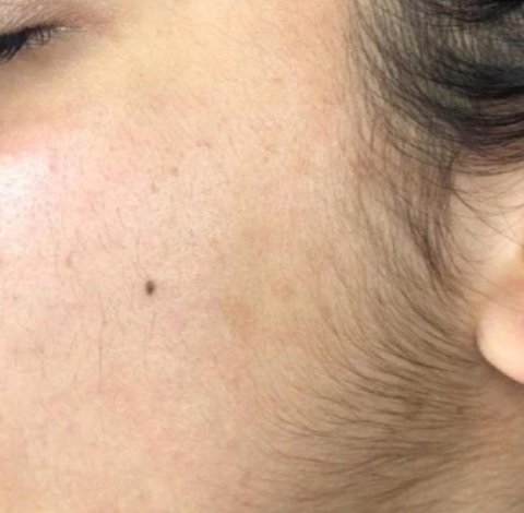 Before Image: Dermaplaning - left-front-oblique