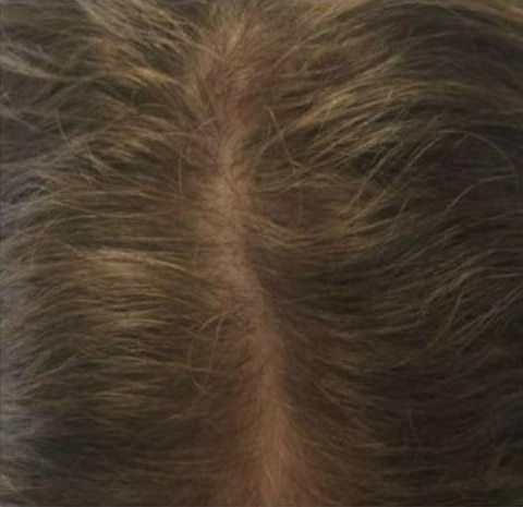 After Image: Hair Restoration - front