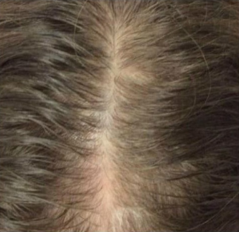 Before Image: Hair Restoration - front