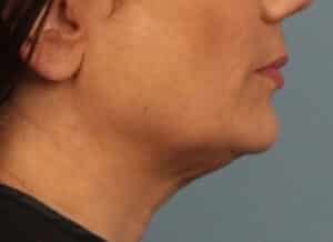 After Image: Kybella