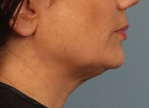 After Image: Kybella - right-side