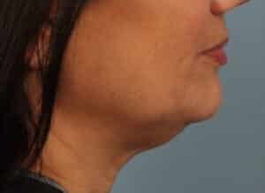 Before Image: Kybella