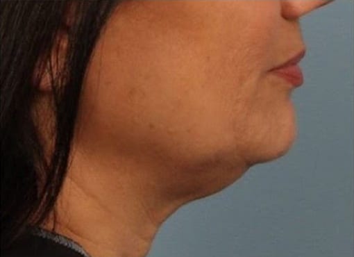 Before Image: Kybella - right-side