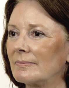 After Image: Laser Resurfacing