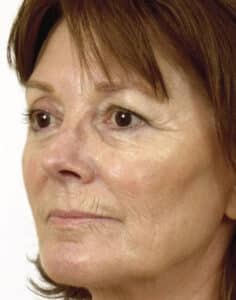 Before Image: Laser Resurfacing