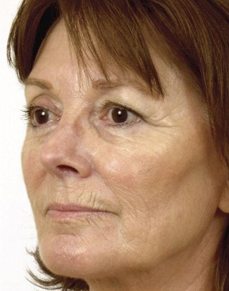 Before Image: Laser Resurfacing - left-front-oblique