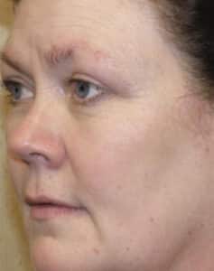 After Image: Laser Treatments