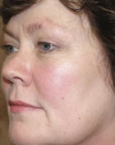 Before Image: Laser Treatments