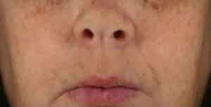 After Image: Chemical Peels