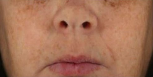 After Image: Chemical Peels - front