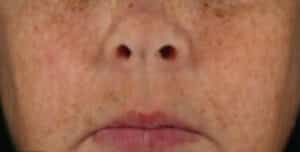 Before Image: Chemical Peels