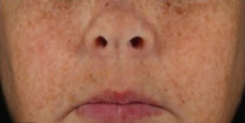 Before Image: Chemical Peels - front