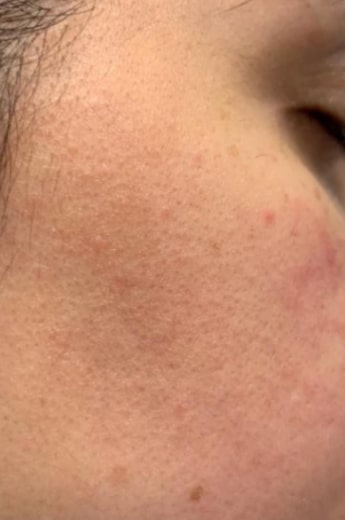 After Image: Dermaplaning - right-front-oblique