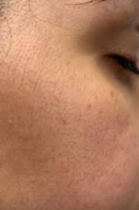 Before Image: Dermaplaning