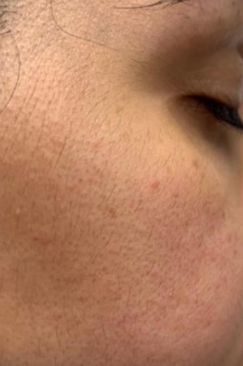 Before Image: Dermaplaning - right-front-oblique
