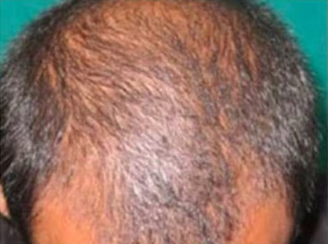 Before Image: Hair Restoration - front