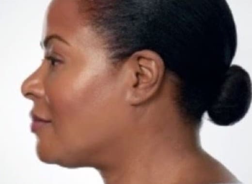 After Image: Kybella - left-side