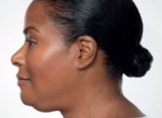 Before Image: Kybella - left-side