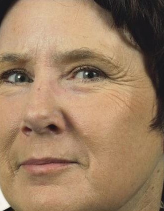 After Image: Laser Resurfacing - left-front-oblique