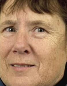 Before Image: Laser Resurfacing