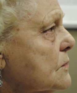 After Image: Laser Treatments
