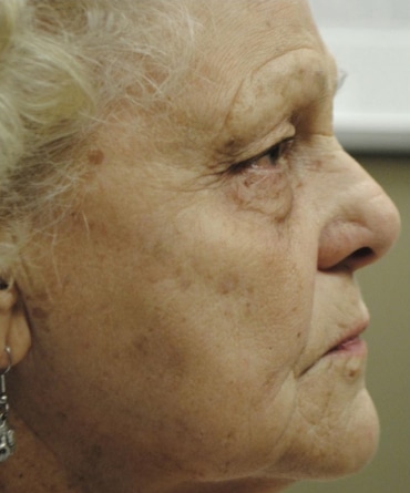 After Image: Laser Treatments - right-side