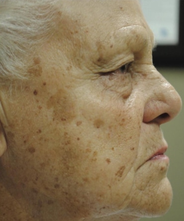 Before Image: Laser Treatments - right-side