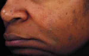 After Image: Chemical Peels