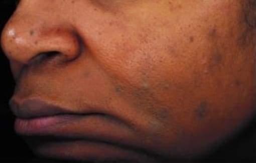 After Image: Chemical Peels - left-front-oblique