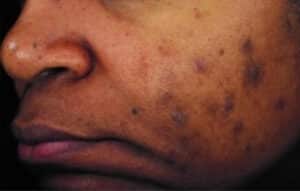 Before Image: Chemical Peels