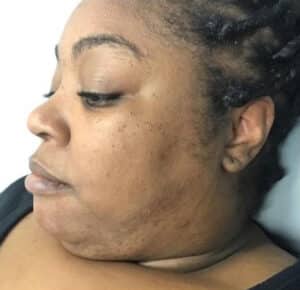 Before Image: Dermaplaning
