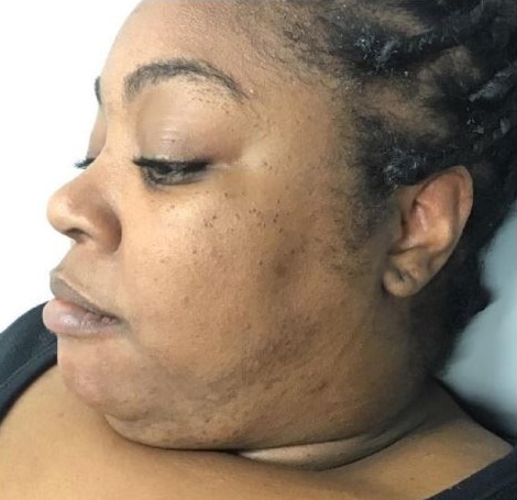 Before Image: Dermaplaning - left-front-oblique