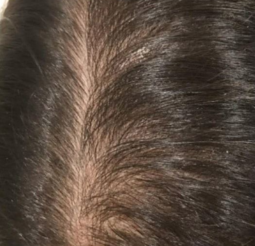 After Image: Hair Restoration - front
