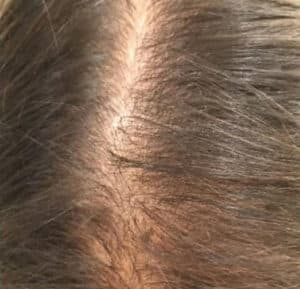 Before Image: Hair Restoration