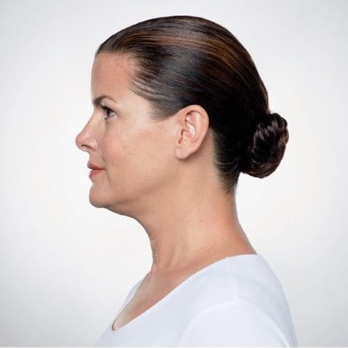 Before Image: Kybella - left-side