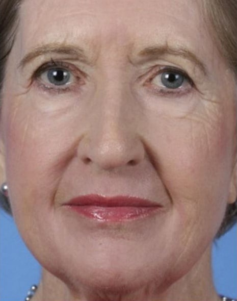 After Image: Laser Resurfacing - front