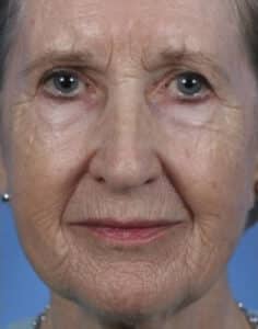 Before Image: Laser Resurfacing