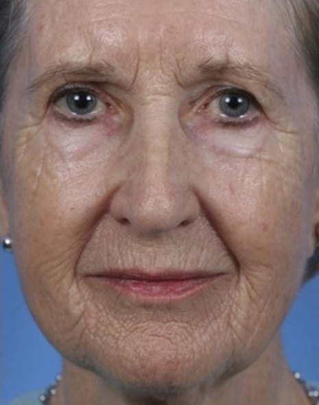 Before Image: Laser Resurfacing - front