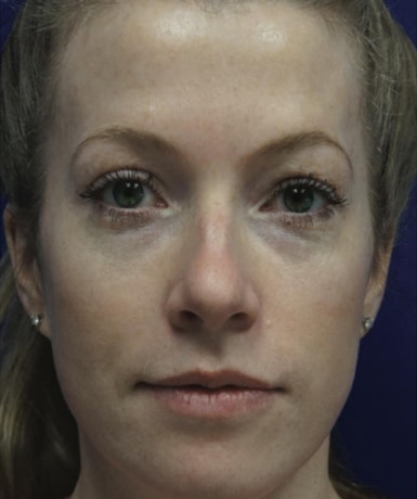 After Image: Laser Treatments - front