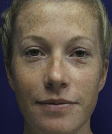 Before Image: Laser Treatments - front