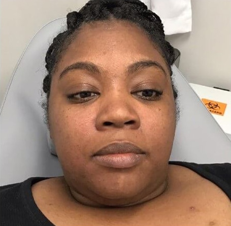 After Image: Dermaplaning - front