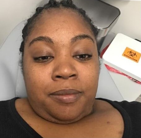 Before Image: Dermaplaning - front