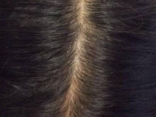 After Image: Hair Restoration - front