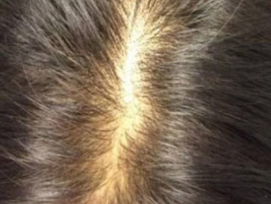 Before Image: Hair Restoration - front