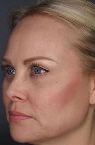 After Image: Kybella - left-front-oblique